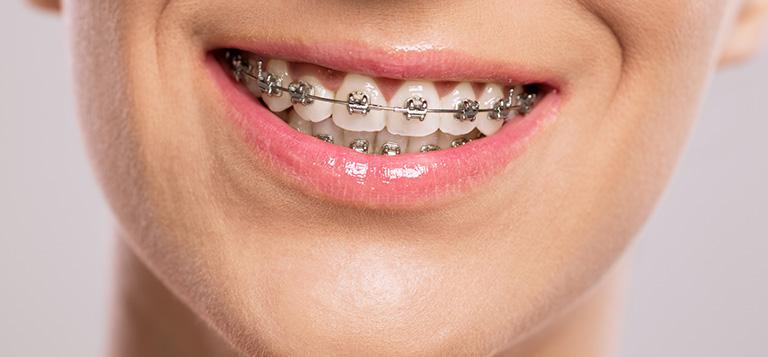 aparat ortodontyczny na zębach